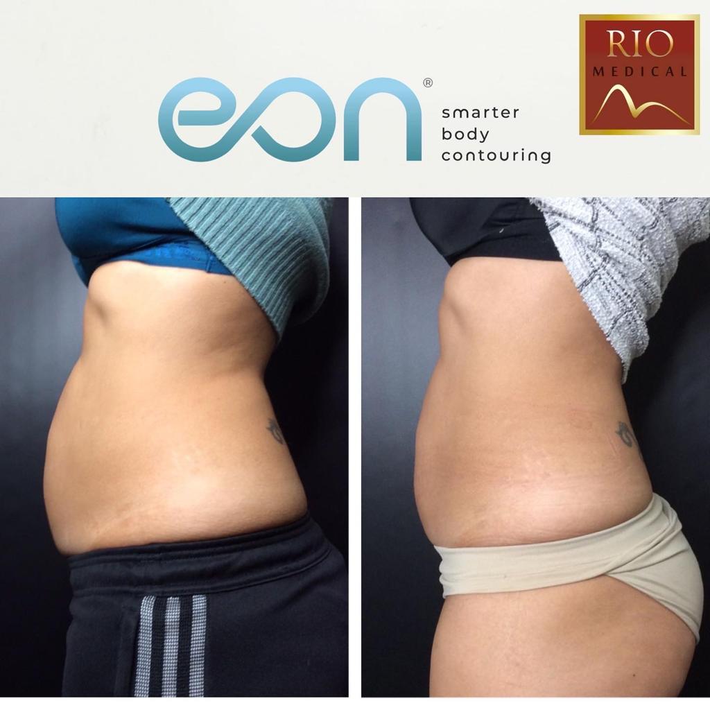 The Eon Laser Is Unlike Any Other Body Sculpting Treatment