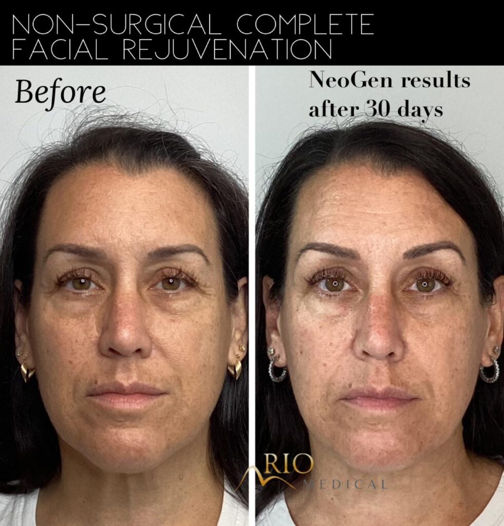 Unlocking Youthful Skin with NeoGen Plasma Treatment at Rio Medical ...